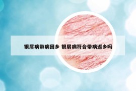 銀屑病帶病回鄉(xiāng) 銀屑病符合帶病返鄉(xiāng)嗎