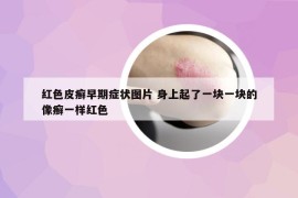 紅色皮癬早期癥狀圖片 身上起了一塊一塊的像癬一樣紅色