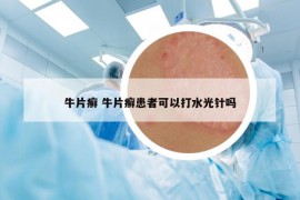 牛片癬 牛片癬患者可以打水光針嗎
