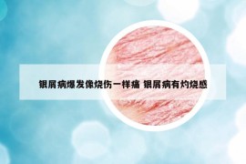 銀屑病爆發(fā)像燒傷一樣痛 銀屑病有灼燒感