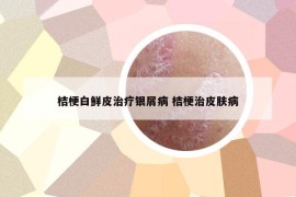 桔梗白鮮皮治療銀屑病 桔梗治皮膚病