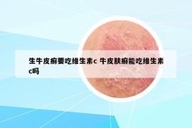 生牛皮癬要吃維生素c 牛皮膚癬能吃維生素c嗎