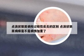 點(diǎn)滴狀銀屑病和過(guò)敏性皮炎的區(qū)別 點(diǎn)滴狀銀屑病癢是不是病情加重了