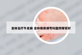 吉林治療牛皮癬 吉林銀屑病專(zhuān)科醫(yī)院哪家好