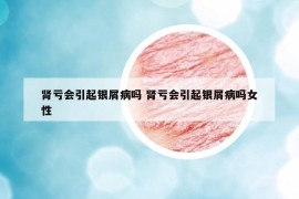 腎虧會(huì)引起銀屑病嗎 腎虧會(huì)引起銀屑病嗎女性