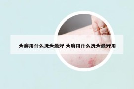 頭癬用什么洗頭最好 頭癬用什么洗頭最好用