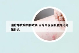 治療牛皮癬的特效藥 治療牛皮皮癬最好藥膏是什么