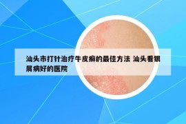 汕頭市打針治療牛皮癬的最佳方法 汕頭看銀屑病好的醫(yī)院