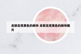 皮膚出現(xiàn)黑色的癬塊 皮膚出現(xiàn)黑色的癬塊圖片