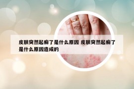 皮膚突然起癬了是什么原因 皮膚突然起癬了是什么原因造成的