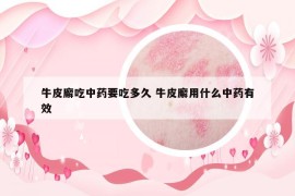 牛皮廨吃中藥要吃多久 牛皮廨用什么中藥有效