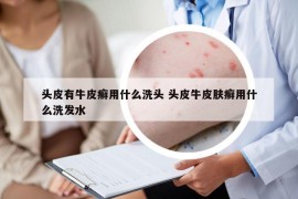 頭皮有牛皮癬用什么洗頭 頭皮牛皮膚癬用什么洗發(fā)水