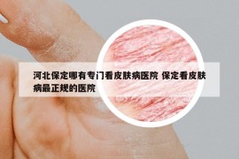 河北保定哪有專門看皮膚病醫(yī)院 保定看皮膚病最正規(guī)的醫(yī)院