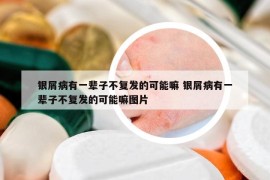 銀屑病有一輩子不復(fù)發(fā)的可能嘛 銀屑病有一輩子不復(fù)發(fā)的可能嘛圖片