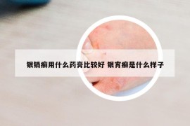 銀銷癬用什么藥膏比較好 銀宵癬是什么樣子