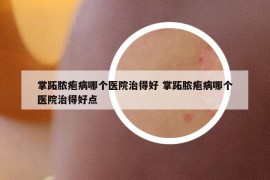 掌跖膿皰病哪個醫(yī)院治得好 掌跖膿皰病哪個醫(yī)院治得好點