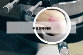 牛皮癬中間白
