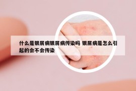 什么是銀屑病銀屑病傳染嗎 銀屑病是怎么引起的會(huì)不會(huì)傳染