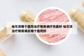 哈爾濱哪個(gè)醫(yī)院治療銀屑病療效最好 哈爾濱治療銀屑病去哪個(gè)醫(yī)院好