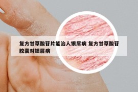復方甘草酸苷片能治人銀屑病 復方甘草酸苷膠囊對銀屑病