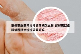邯鄲燕趙醫(yī)院治療銀屑病怎么樣 邯鄲燕趙皮膚病醫(yī)院治痘痘效果好嗎