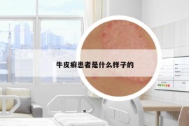 牛皮癬患者是什么樣子的