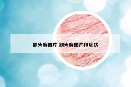 額頭癬圖片 額頭癬圖片和癥狀