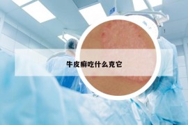 牛皮癬吃什么克它