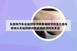 從鄭州汽車北站到鄭州銀屑病研究所坐幾路車 鄭州火車站到鄭州銀屑病研究所有多遠(yuǎn)
