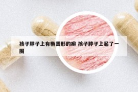 孩子脖子上有橢圓形的癬 孩子脖子上起了一圈