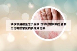 塊狀銀屑病是怎么回事 斑塊狀銀屑病患者會(huì)出現(xiàn)哪些常見的表現(xiàn)或現(xiàn)象