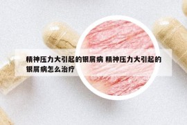 精神壓力大引起的銀屑病 精神壓力大引起的銀屑病怎么治療