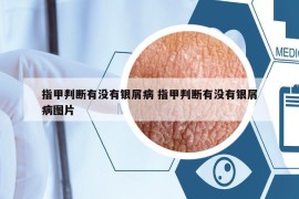 指甲判斷有沒有銀屑病 指甲判斷有沒有銀屑病圖片