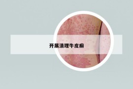 開展清理牛皮癬