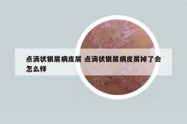 點(diǎn)滴狀銀屑病皮屑 點(diǎn)滴狀銀屑病皮屑掉了會(huì)怎么樣