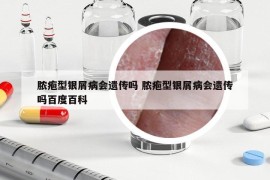 膿皰型銀屑病會(huì)遺傳嗎 膿皰型銀屑病會(huì)遺傳嗎百度百科