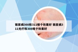 銀屑病308和311哪個(gè)效果好 銀屑病311光療和308哪個(gè)效果好
