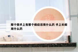 那個我手上有那個癬應(yīng)該用什么藥 手上長癬用什么藥
