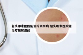 包頭哪家醫(yī)院能治療銀屑病 包頭哪家醫(yī)院能治療銀屑病的