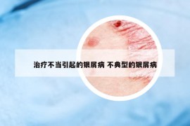 治療不當(dāng)引起的銀屑病 不典型的銀屑病