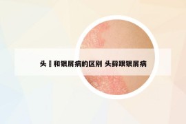 頭廯和銀屑病的區(qū)別 頭蘚跟銀屑病