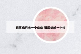 銀屑病只有一個(gè)痘痘 銀屑病就一個(gè)痘