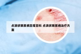 點滴狀銀屑病百度百科 點滴狀銀屑病治療方案