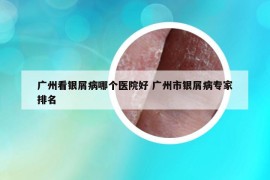 廣州看銀屑病哪個醫(yī)院好 廣州市銀屑病專家排名