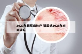 2023年銀屑病診療 銀屑病2025年有突破嗎