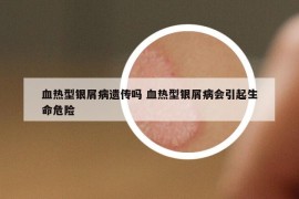 血熱型銀屑病遺傳嗎 血熱型銀屑病會引起生命危險