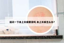 請(qǐng)問(wèn)一下身上長(zhǎng)癬要緊嗎 身上長(zhǎng)癬怎么辦?