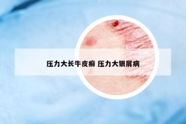 壓力大長牛皮癬 壓力大銀屑病