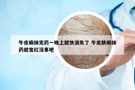 牛皮癬抹完藥一晚上就快消失了 牛皮膚癬抹藥就變紅沒事吧
