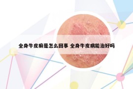 全身牛皮癬是怎么回事 全身牛皮病能治好嗎